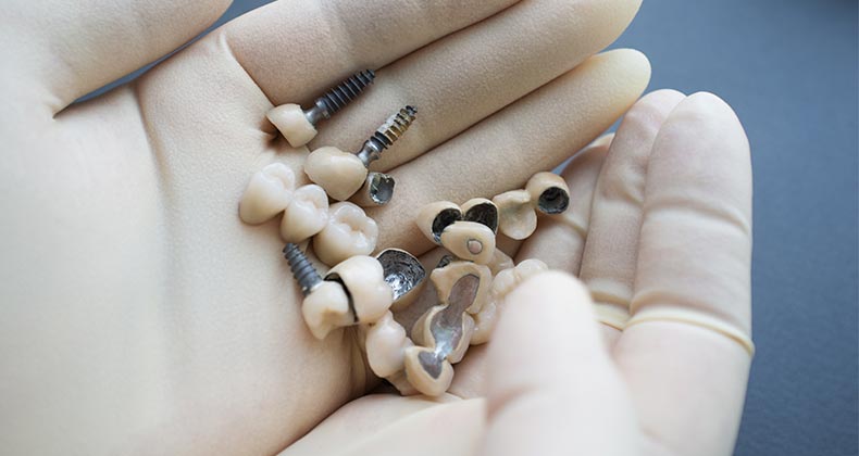 Dental implants | Golubovy/Shutterstock.com